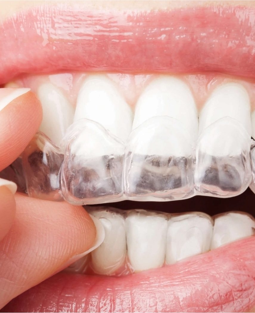 A woman putting the Aligners into her mouth and over her teeth