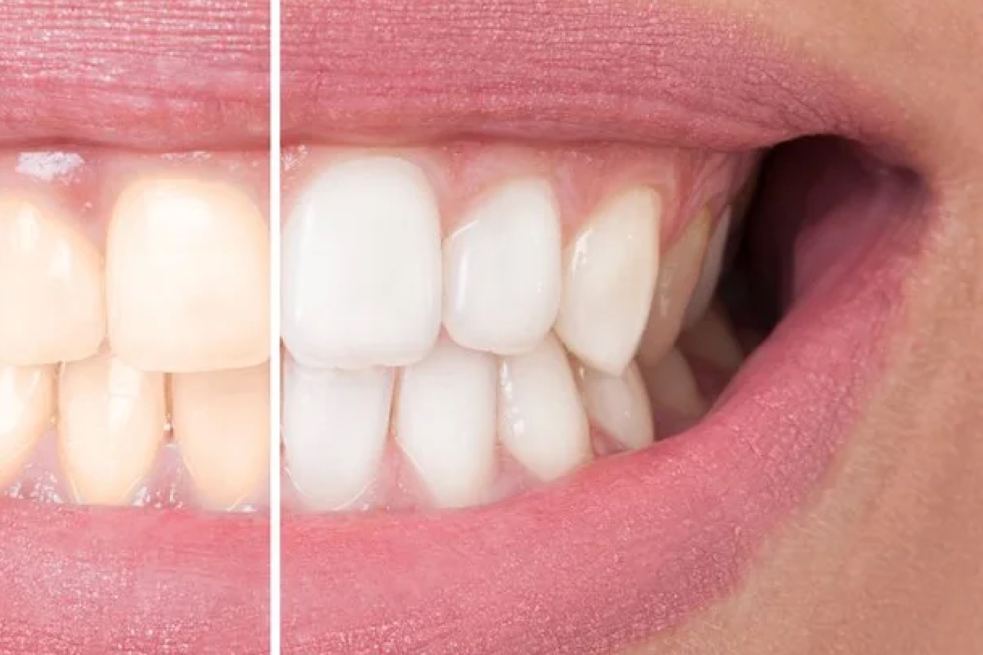 What is Teeth Whitening