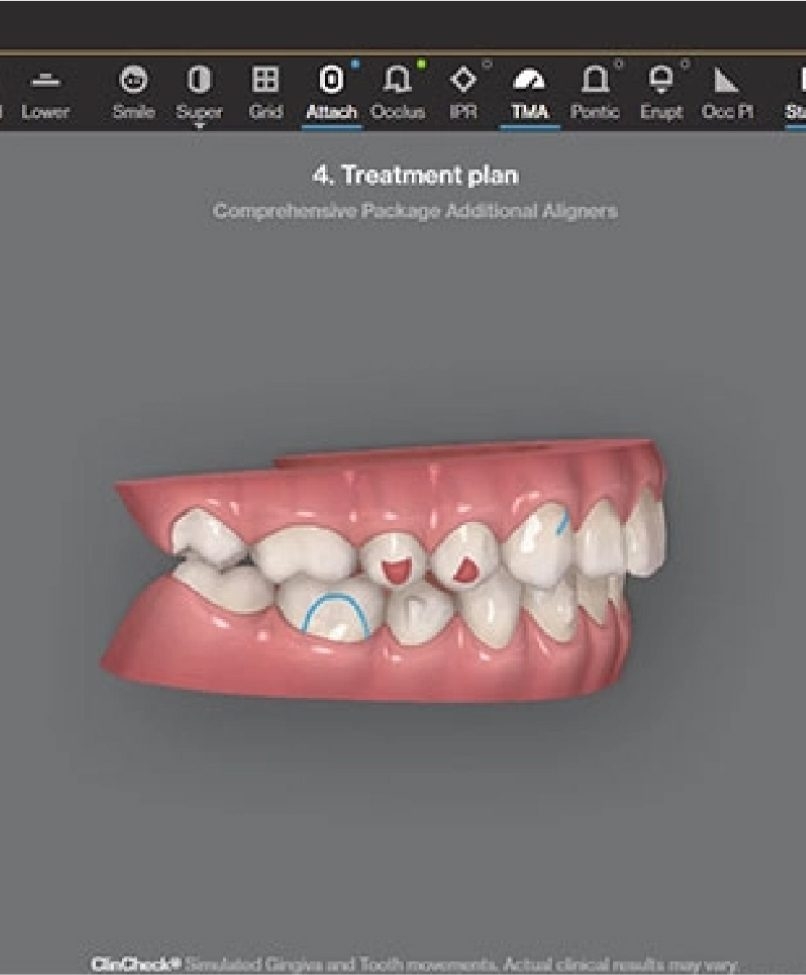 A 3D mould of top and bottom rows of teeth